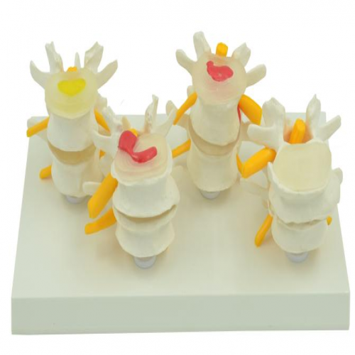 4階段病（bìng）變腰椎模型