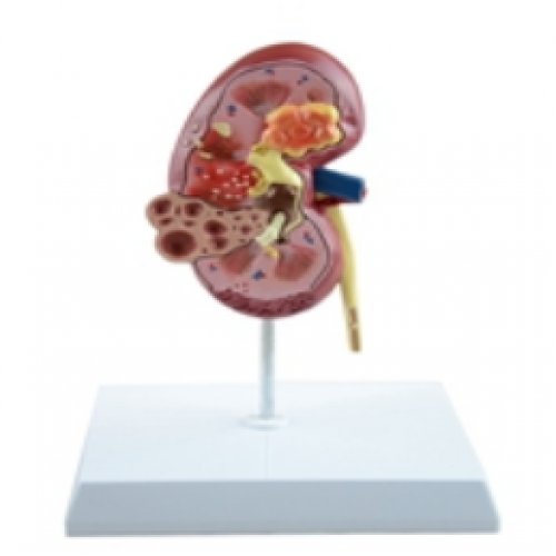 病（bìng）理腎模型