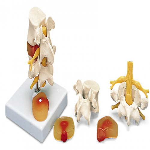 2節腰椎帶2個病變椎間盤模型（xíng）