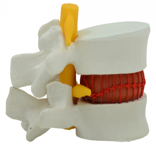 椎間盤突出模型（動態演（yǎn）示）