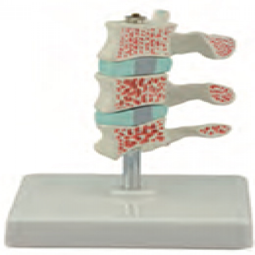 骨質疏鬆症模型